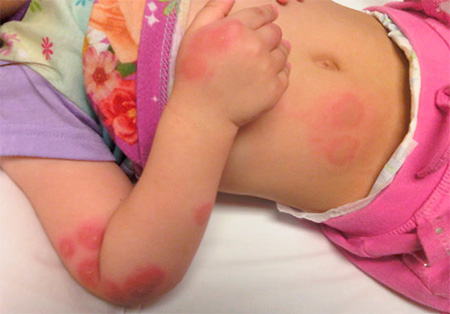 аллергия на укусы клопов у детей